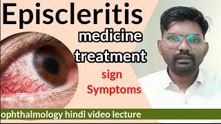 Episcleritis treatment  Episcleritis disease in eye  sclera anatomy  Episcleritis  optometry [upl. by Fakieh]