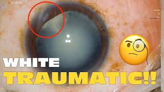 Phaco Clip 241  Traumatic White Cataract [upl. by Annazor]