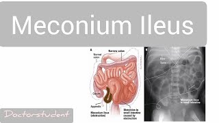 Meconium Ileus [upl. by Saloma]