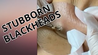 Stubborn blackheads [upl. by Ahsieni235]