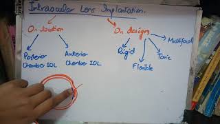 INTRAOCULAR LENS IMPLANT explained in simple way [upl. by Amisoc]