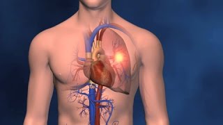 Embolism Pulmonar y TVP [upl. by Ihcelek980]