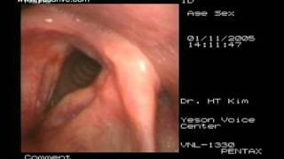 Laryngoplasty of sulcus vocalis [upl. by Giana]