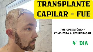 TRANSPLANTE CAPILAR  TÉCNICA FUE 4° DIA PÓS OPERATÓRIO [upl. by Forelli]