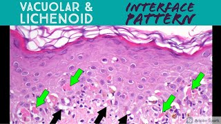 Vacuolar vs Lichenoid Interface Dermatitis Pattern  Inflammatory Dermpath Basics [upl. by Radloff]