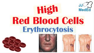 High Red Blood Cells Erythrocytosis  Causes Signs and Symptoms and Treatment [upl. by Konikow]