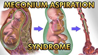 Meconium Aspiration Syndrome Pathophysiology Signs and Symptoms Diagnosis and Treatment [upl. by Evets33]