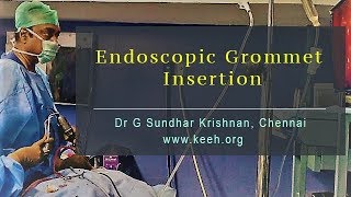 Endoscopic Grommet Insertion  Dr G Sundhar Krishnan Chennai [upl. by Aicsile]