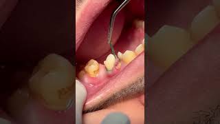 Removing retraction cord after tooth RCT amp composite restoration [upl. by Llerrahs]