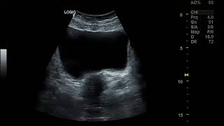 Bicornuate uterus pregnancy [upl. by Donelson]