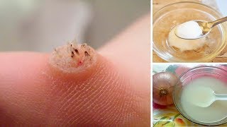 How to Get Rid of Warts Naturally [upl. by Roinuj]