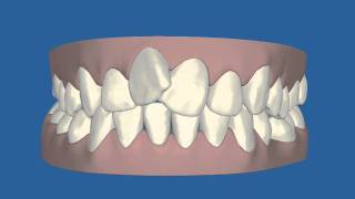 Invisalign Clincheck 3 [upl. by Ahsiuqat424]