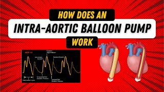 How Does an Intra Aortic Balloon Pump Work Guide for Nurses [upl. by Seema536]