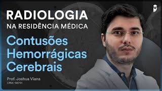 Contusões Hemorrágicas Cerebrais  Radiologia na Residência Médica [upl. by Stuppy]