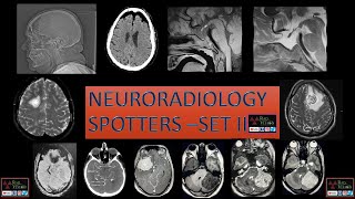 NEURORADIOLOGY SPOTTERS SET II [upl. by Ardnauqal]