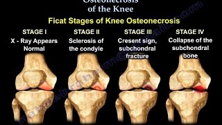 Osteonecrosis Of The Knee  Everything You Need To Know  Dr Nabil Ebraheim [upl. by Zavras]