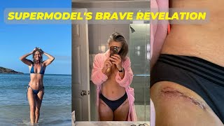 Supermodels Brave Revelation Stunning Instagram Pics Show Hip Surgery Scars [upl. by Shamma]