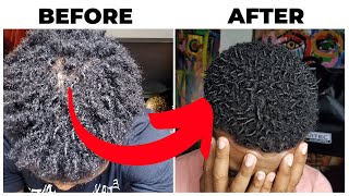 Hair Loss Journey  All Natural Remedy To REGROW YOUR HAIR [upl. by Cohlette]