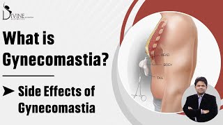 Gynecomastia Kya Hota hai  Side Effects of Gynecomastia  What is Gyno  What is Gynecomastia [upl. by Asillim862]