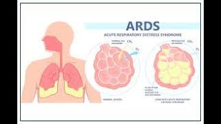 ARDS  ARDS  causes symptoms  pathophysiology  diagnosis treatment  ARDS medicine lecture [upl. by Wilt]