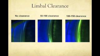 Scleral Lens Fitting Basics May 13 2015 [upl. by Pontius808]