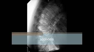 Transforming My Own Scoliosis [upl. by Lovato264]