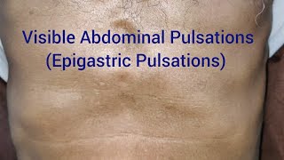 Clinical Examination Visible Epigastric Pulsations [upl. by Gladys]