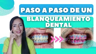 ¿Cómo se hace un blanqueamiento dental paso a paso [upl. by Rickert]