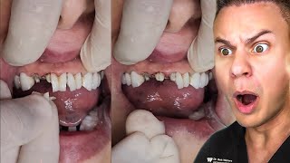 Before Getting Veneers You NEED To Know THIS [upl. by Lehsar]