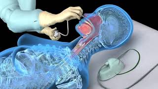 Nasotracheal suctioning NTS  3D animation [upl. by Moriah]