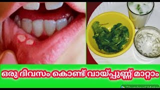 ഒരു ദിവസം കൊണ്ട് വായ്പ്പുണ്ണ് മാറ്റാം Vaya Punnu Maran Malayalam Mouth Ulcer Treatment Malayalam [upl. by Vallo]