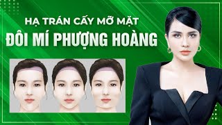 Tư vấn thẩm mỹ HẠ TRÁN và CẤY MỠ MẶT giúp khuôn mặt trở nên baby trẻ trung hơn  Nhã Lê JT Angel [upl. by Ehcrop]