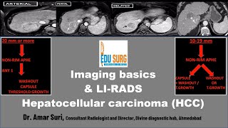 Imaging for Liver Cancer amp LIRADS Hepatocellular carcinoma radiology masterclass  Edusurg clinics [upl. by Etheline828]