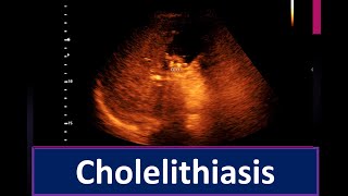 Cholelithiasis  Thickened sludge within the Gall Bladder lumen  Enlarge prostate [upl. by Enitsirc]