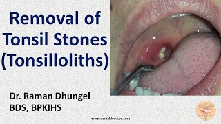 Tonsil Stone Removal  Tonsillolith removal by Dr Raman Dhungel [upl. by Janene]