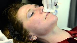 Dermapen Treatment by Cosmetic Laser MD [upl. by Hemminger]