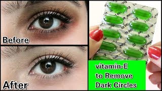 Remove Dark Circles in 3 days with Vitamin E 100 Works [upl. by Longley]