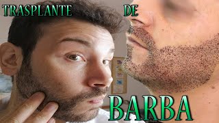 TRASPLANTE DE BARBA [upl. by Aretha]