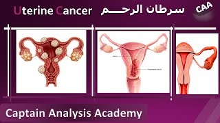 E4Endometrial Cancer Uterine cancer سرطان الرحم اسبابة وطرق تشخيصة و علاجه [upl. by Cari]