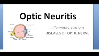 Ophthalmology Optic neuritis Papillitis NeuroRetinitis RetroBulbar phosphenes uhthoff pulfrich [upl. by Viridissa696]