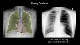 How to Interpret a Chest XRay Lesson 4  Airways Bones and Soft Tissues [upl. by Adnaloj356]