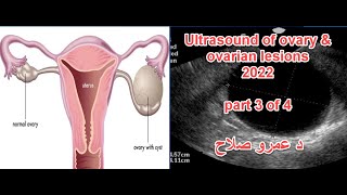 Ultrasound of ovary and ovarian lesions part 3 of 4  د عمرو صلاح  كورس النسا 2022 [upl. by Arabeila]