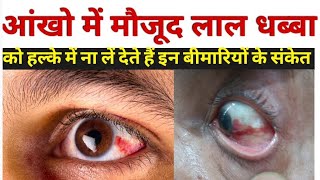 आंख लाल होने का कारण  subconjunctival hemorrhage in hindi  subconjunctival hemorrhage treatment [upl. by Nazler]