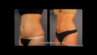 Liposuction Before and After Abdomen Area Part 1  Silk Touch Medspa Boise [upl. by Normand112]