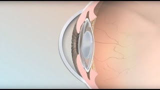 Intraocular Lenses  Mayo Clinic [upl. by Dombrowski557]