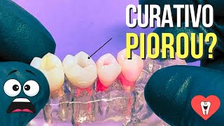 PULPITE IRREVERSÍVEL ENDODONTIA SEM COMPLICAÇÃO  Endolovers [upl. by Jaela425]