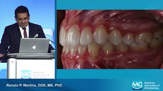 Vertical Control Aligners vs Brackets  Annual Session of the AAO 2024 [upl. by Baruch]