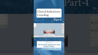 Clinical Indications Crowding Part 4 [upl. by Esmerelda]