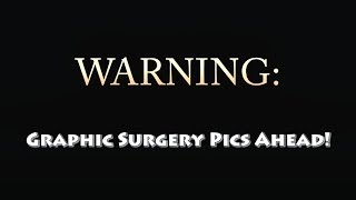 Hysterectomy Surgery Information And Pictures Episode 250 [upl. by Ajna]