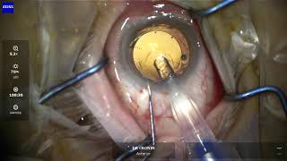 Secondary sulcus intraocular lens surgery explained for patients [upl. by Anyaj]